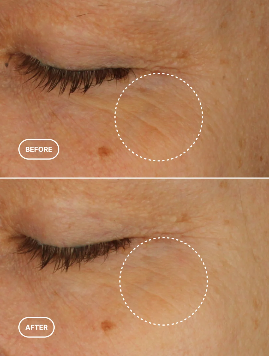 Before and after comparison of skin texture around an eye.