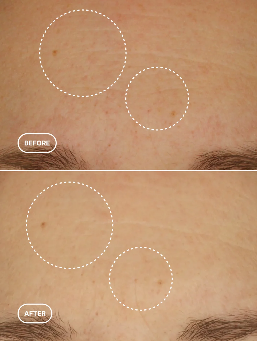 Before and after comparison of skin with blemishes on a beige background