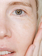 Close-up of a person's eye with visible freckles and skin texture.