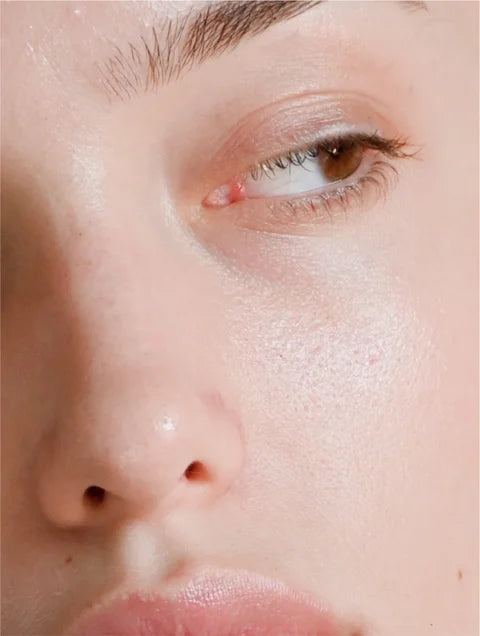 Close-up of a person's eye with a visible pimple.