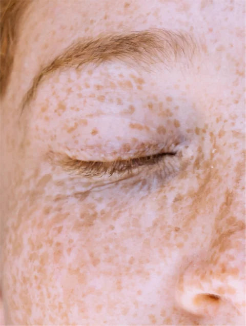 Close-up of a person's eye with visible freckles on a light skin tone.