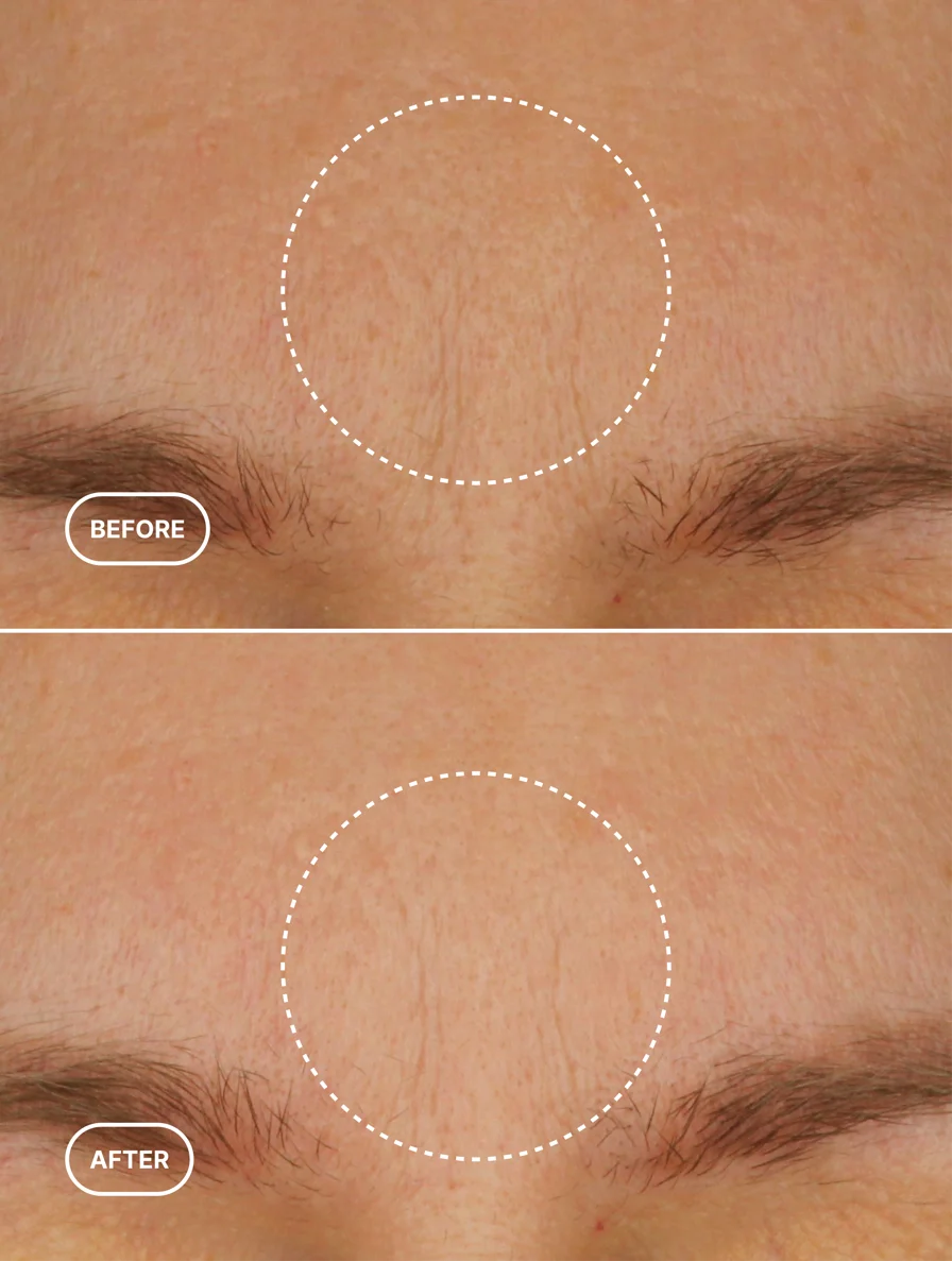 Before and after comparison of skin texture on a person's face.