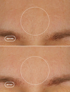 Before and after comparison of skin texture on a person's face.